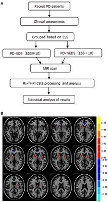 Abnormalities in the Fractional Amplitude of Low-Frequency Fluctuation and Functional Connectivity in Parkinson's Disease With Excessive Daytime Sleepiness